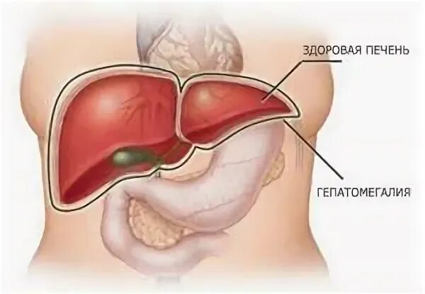 Гепатомегалия печени и поджелудочной железы что это