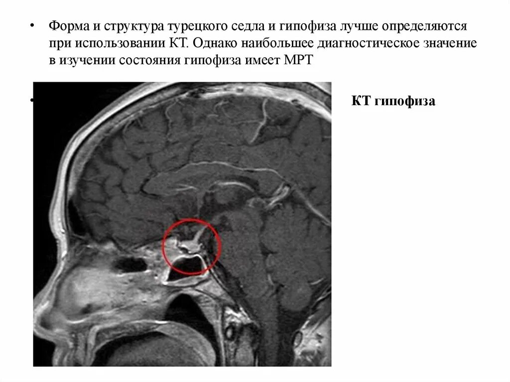 Симптом турецкого седла. Анатомия турецкого седла рентген. Мрт головного мозга аденома гипофиза. Рентген турецкого седла опухоль гипофиза. Лучевая диагностика гипофиза.