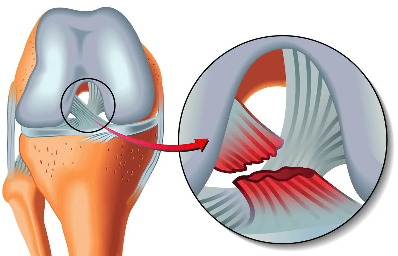 Травма связок сустава. Повреждение ПКС коленного сустава. Разрыв ПКС коленного сустава. Передняя крестообразная связка коленного сустава разрыв.