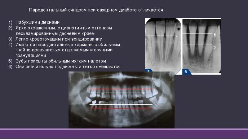 Полость страдать. Пародонтальный синдром при сахарном диабете. Пародонтальный синдром при сахарном. Проявление сахарного диабета в полости рта. Изменения в полости рта при сахарном диабете.