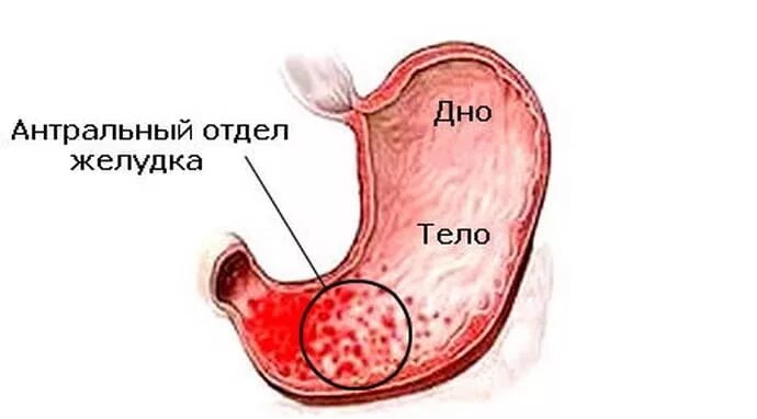 кардиальный антральный пилорические отделы желудка. анатомия желудка антральный отдел. анатомия желудка антральный отдел. антральный отдел. пилороантральный отдел желудка.