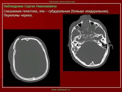 Особенности гематом