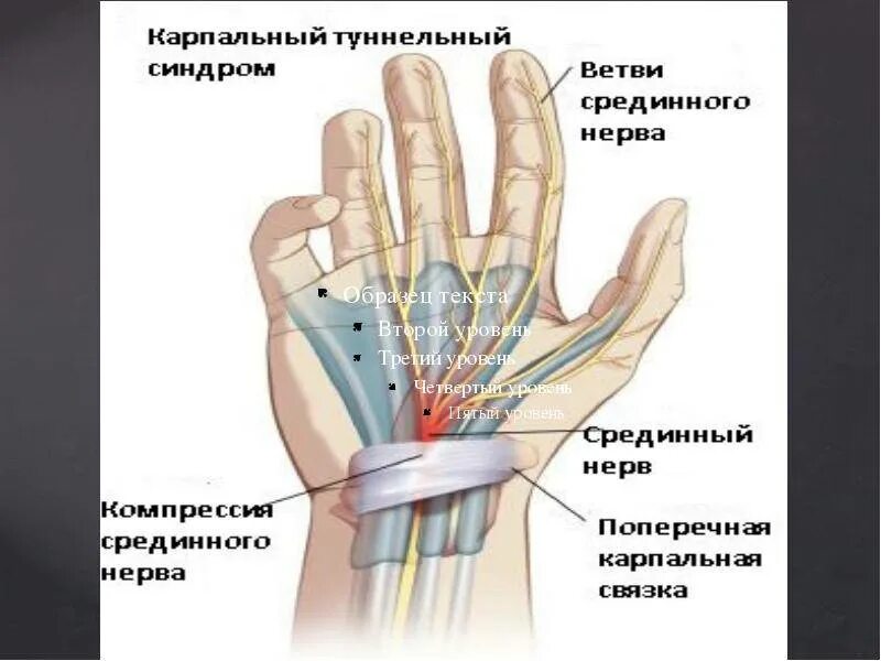 Невропатия локтевого нерва туннельный синдром. Сенсорная нейропатия локтевого нерва. Туннельная невропатия срединного нерва. Компрессионно-ишемическая нейропатия срединного нерва. Нейропатия кисти