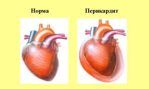 Перикардит это