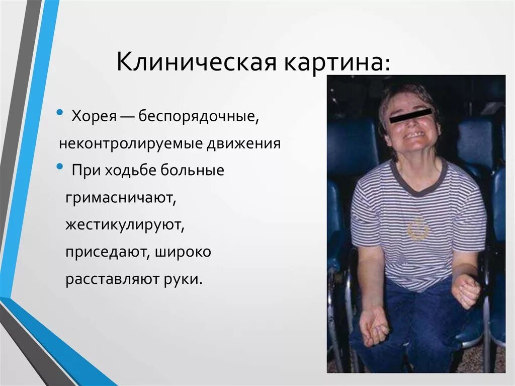 Хорея хантингтона. Болезнь гентингтона. хорея болезнь. болезнь хорея гентингтона.