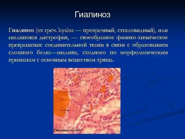 Гиалиновая дистрофия. Гиалиноз артериол селезенки микропрепарат. Гиалиноз артерий селезенки. Гиалиноз сосудов яичника. Гиалиновая дистрофия.