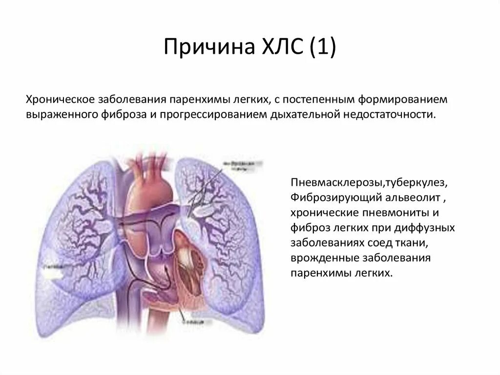 Хроническая легочно сердечная недостаточность. Хроническое легочное сердце патанатомия. Легочная паренхима. Паренхима легких. Причины ХЛС.