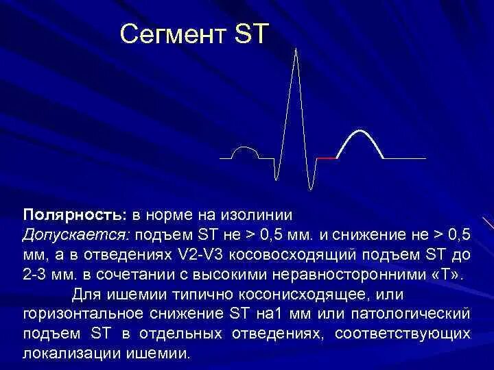 Высокий зубец т на ЭКГ В v2 v3. Отрицательные зубцы т на ЭКГ В v2 v5. Зубец r на ЭКГ. Двухфазный зубец т в 3 отведении. Мв на экг