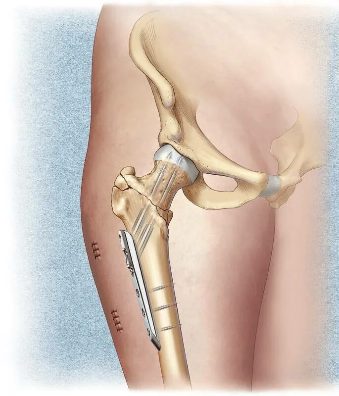 Чрезвертельный перелом шейки бедра. Интрамедуллярный остеосинтез тазобедренного сустава. Перелом шейки бедренной кости. Перелом шейки бедра эндопротезирование тазобедренного сустава. Как делают операцию на тазобедренном