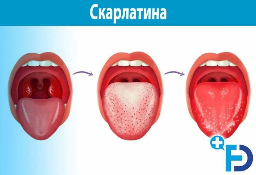 Горло при скарлатине у детей.