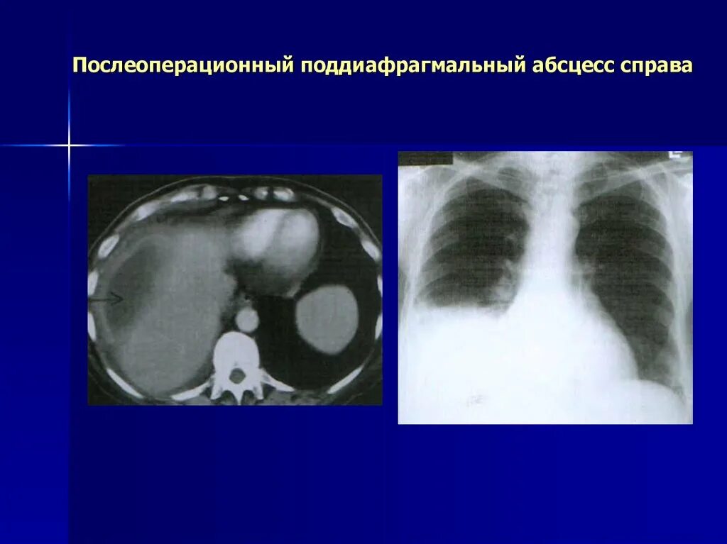 Стерильный абсцесс. Стерильный абсцесс. Стерильный абсцесс. Паратонзиллярный абсцесс мкб 10. Первая помощь при абсцессе.