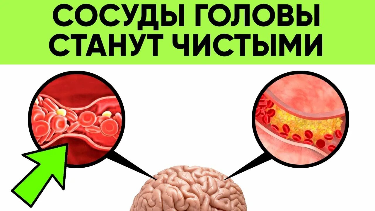 Очистка сосудов головы. Чистка сосудов головного мозга. Чистка сосудов головного МО. Как почистить сосуды головного мозга. Врачи для чистки сосудов головы.