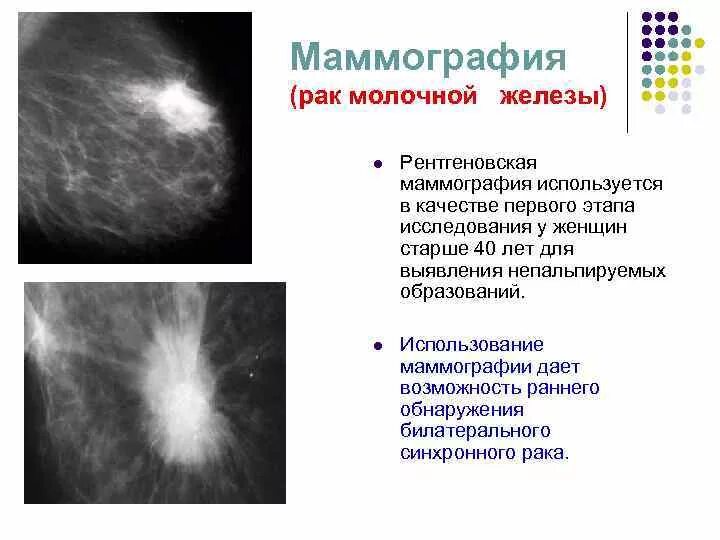 Рак молочной железы 2 стадия отзывы