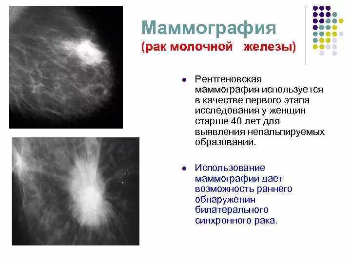 Маммография старый. Маммография молочных желез РМЖ. Рик молочной железы маммографич. Онкология на маммографии. Рентгеновская маммография.