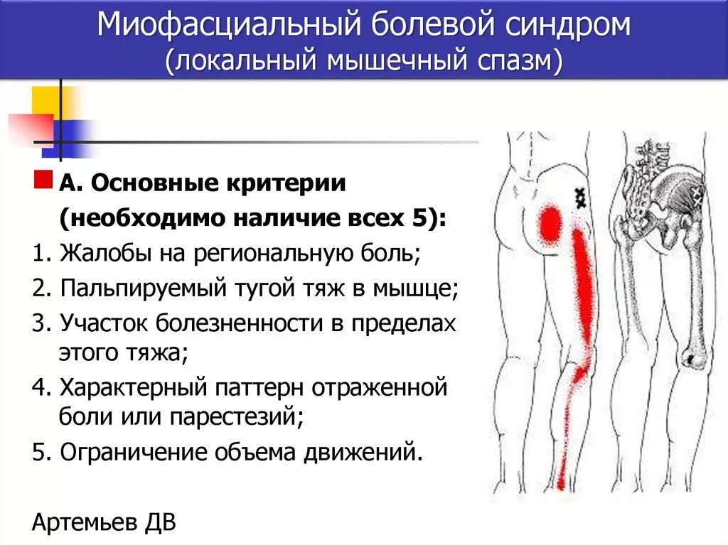 Причина боли области. Миофасциальный синдром бедра. Миофасциальный синдром мышц бедра. Миофасциальный синдром пояснично-крестцового.