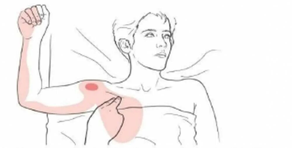 Сводить левую сторону. Триггерные точки малой грудной мышцы. Миофасциальный синдром малой грудной мышцы. Триггерные точки в грудной мышце. Триггерные точки в малой грудной.