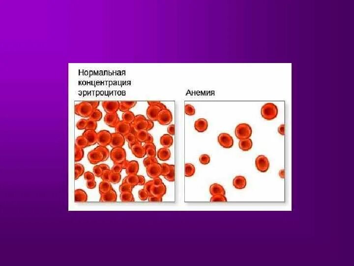 Сколько хромосом содержит эритроцит собаки. Уменьшение объема эритроцитов характерно для анемии. Нормальная концентрация эритроцитов. Анемия при нормальных эритроцитах. Снижение эритроцитов при анемии.