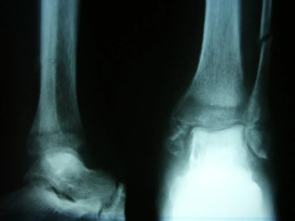 консолидация перелома лодыжки. 70. закрытый перелом наружной лодыжки. консолидация перелома лодыжки. чрезсиндесмозный перелом наружной лодыжки.