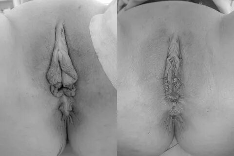 Slideshow phaloplasty porn.