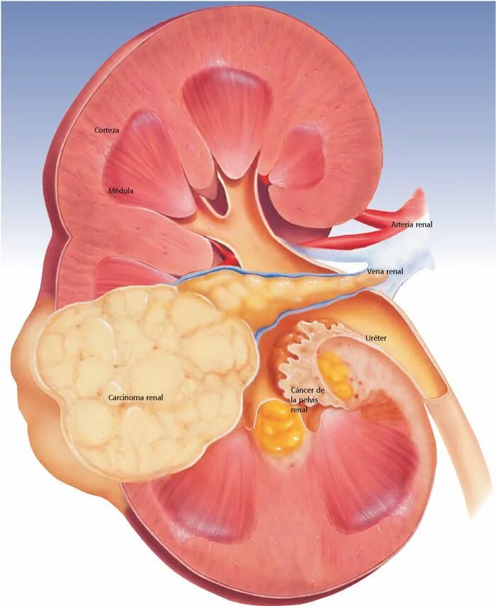 Рак почки причины. Карцинома лоханки почки. Опухоли почечной лоханки и мочеточника. Доброкачественная опухоль почечной лоханки. Опухоли почечной паренхимы.