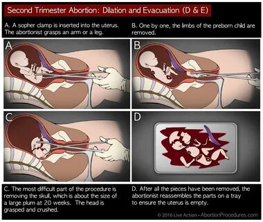 Abortionist flees the room in horror after seeing a second trimester aborti...