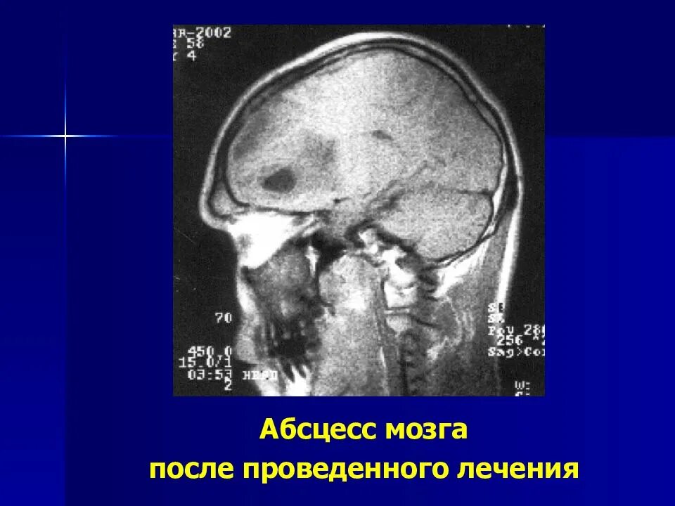 Абсцесс мозга. Орбитальные и внутричерепные осложнения. Риногенный абсцесс мозга. Внутричерепной абсцесс. Абсцесс мозга осложнения.