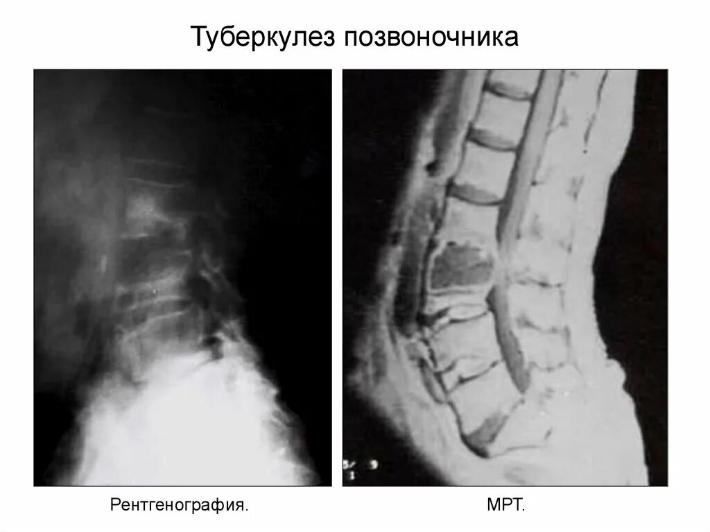 Спондилит рентген. Спондилит позвоночника рентген. Натечник позвоночника туберкулезный спондилит. Туберкулез спондилит позвоночника.