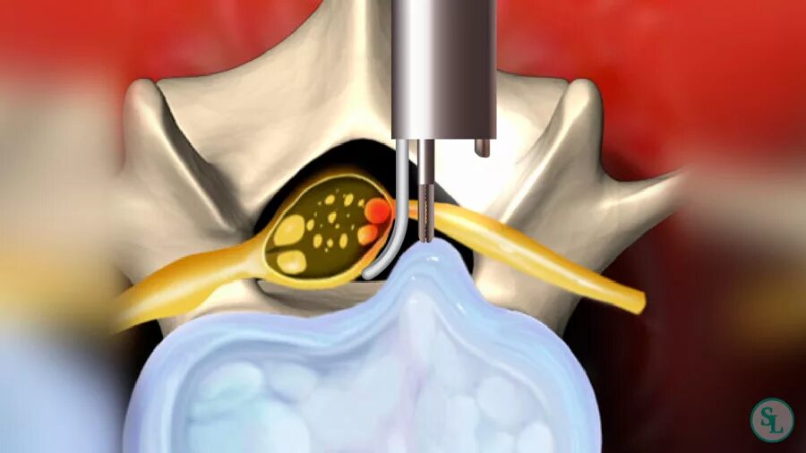 Операция межпозвоночной грыжи микродискэктомия. Микродискэктомия грыжи позвоночника. Эндоскопическая дискэктомия грыжи позвоночника. Микродискэктомия грыжи позвоночника поясничного отдела. Позвоночник операция лазером