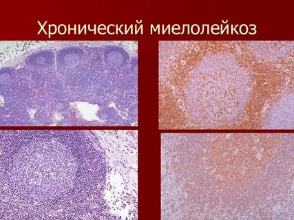 Миелолейкоз