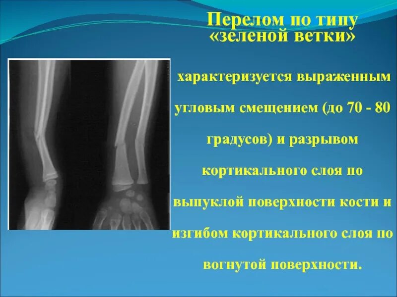 Признаки переломов у детей. Поднадкостничный перелом по типу зеленой веточки. перелом по типу зеленой веточки рентген. перелом по типу зеленой веточки у детей рентгенограмма.