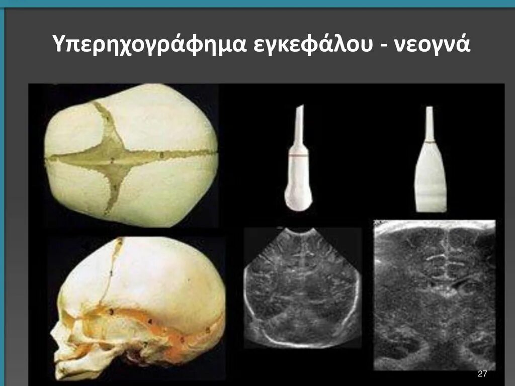 Нсг головного. УЗИ головного мозга нейросонография. Нейросонография новорожденных патология. НСГ (нейросонография) новорожденного. Нейросонография через Родничок.