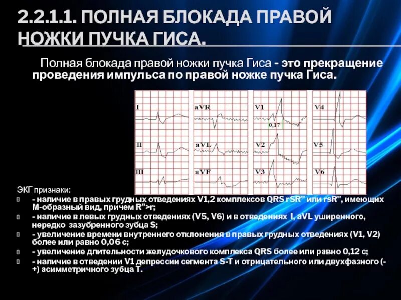 Что означает блокада правой ножки. Полная блокада правой ножки пучка Гиса. Полная блокада правой ножки пучка. Полная блокада правой ножки. Синусовая тахикардия неполная блокада правой ножки.