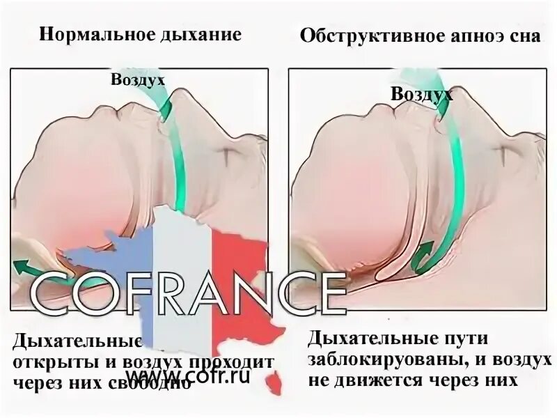 При засыпании останавливается дыхание. Остановка дыхания во сне. Синдром апноэ во сне. Апноэ гипопноэ сна.