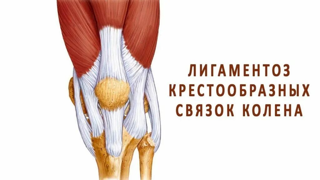 Лигаментоз крестообразных связок коленных. Лигаментоз надколенника. Лигаментоз коленного сустава. Лигаментоз крестообразных связок коленного сустава. Лигаментоза связок сустава.