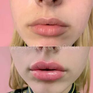 Губы до и после увеличения 0.5