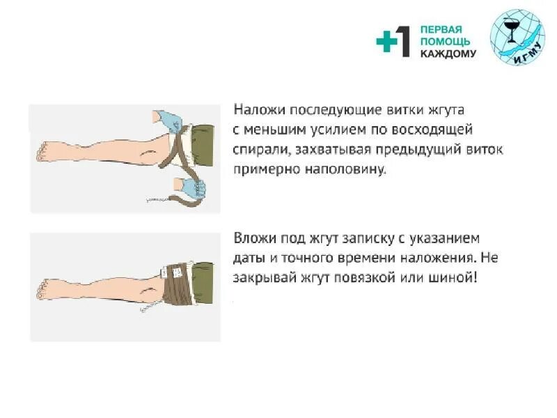 Технику наложения жгута на конечности