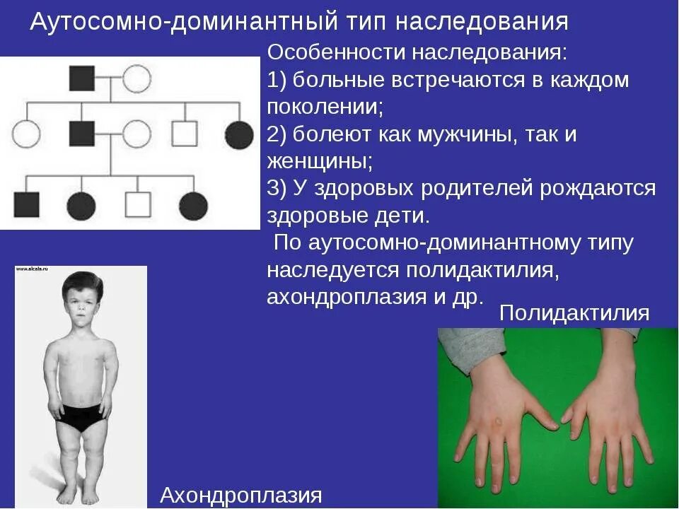 Аутосомное наследование пример. Аутосомно-доминантный Тип наследования. Аутосомно-доминантный Тип наследования болезни. 1.Доминантный-аутосомно Тип наследования. Болезнь Марфана Тип наследования.