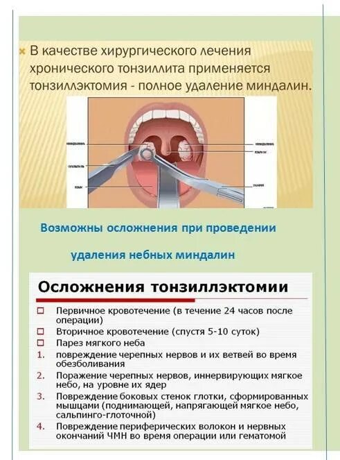 Тонзиллит лечение домашними средствами. Осложнения хронического тонзиллита.