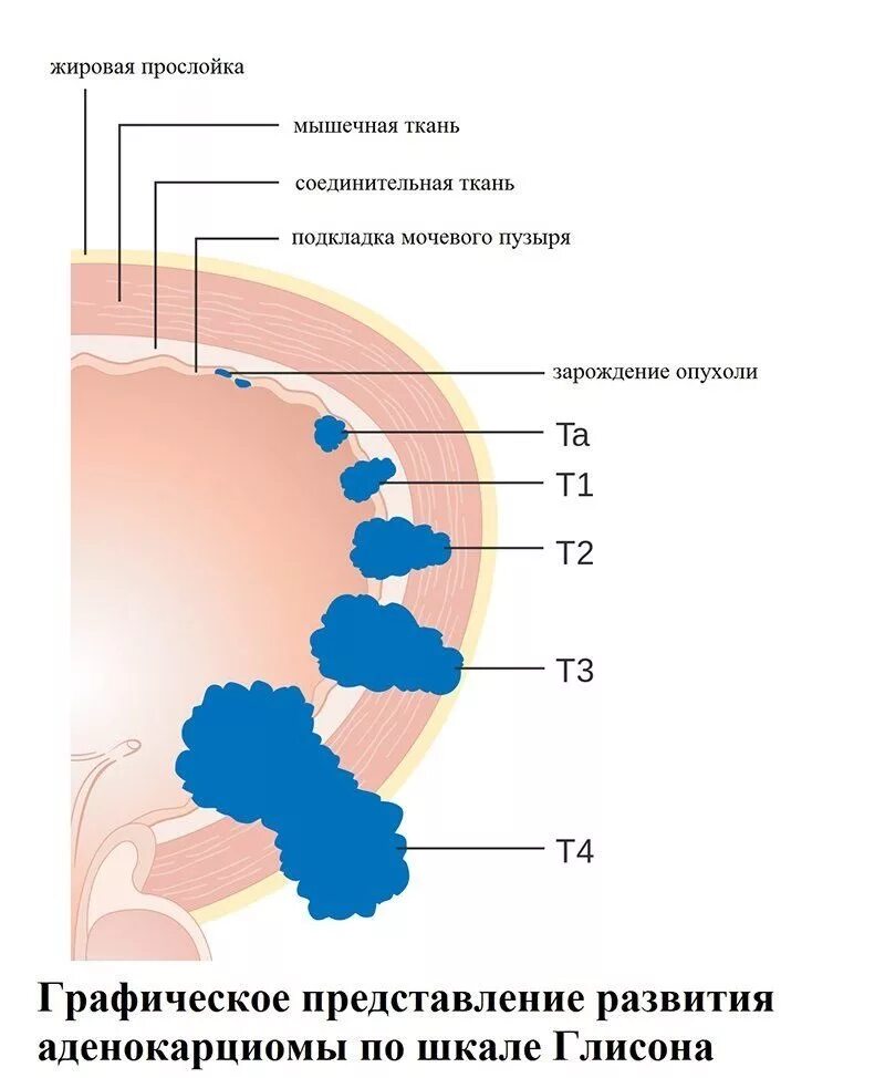 Глисон простата. Аденокарцинома предстательной железы по глисону. Классификация по глиссону. Шкала Глиссона. Шкала по глиссону.