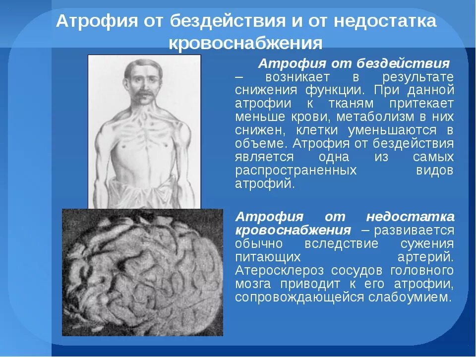 Атрофия головного мозга продолжительность. Атрофия мышечной ткани,профилактика. Патологическая атрофия. Атрофия вызванная недостаточностью кровоснабжения.