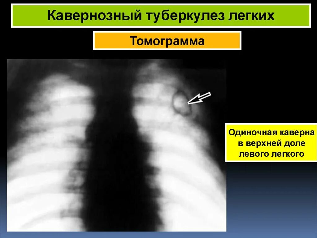 Фиброзно-кавернозный туберкулез рентген. Каверна туберкулез рентген. Кавернозный туберкулез легкого рентген. Кавернозный туберкулез каверна.