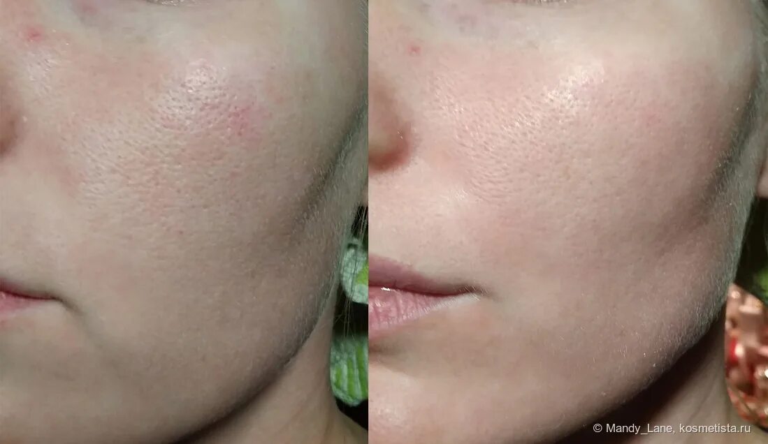 Альгинатная маска до и после. Аллергия на альгинатную маску. Реакция на коже после альгинатной маски. Альгинатная маска для лица с коэнзимом q10 эффект до и после применения.