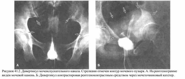 Стриктура уретры рентген. Дивертикул уретры на рентгене.