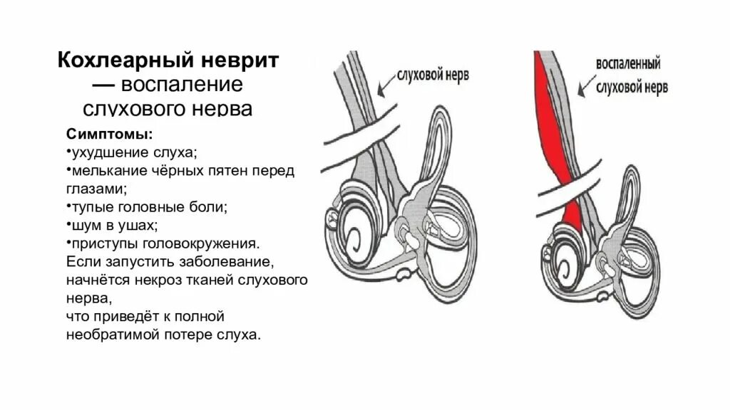 Поражение слухового нерва. Кохлеарный неврит слухового нерва. Воспаление слухового нерва. Слуховой нерв симптомы поражения. Неврит слухового нерва симптомы.