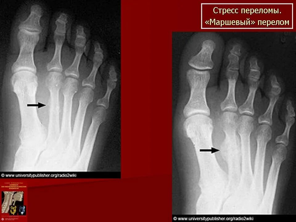 Перелом кости стопы сколько заживает у взрослых. Стресс перелом плюсневой кости стопы. Стресс перелом плюсневой кости стопы рентген. Плюсневая кость стрессовый перелом. Маршевый перелом плюсневой кости рентген.