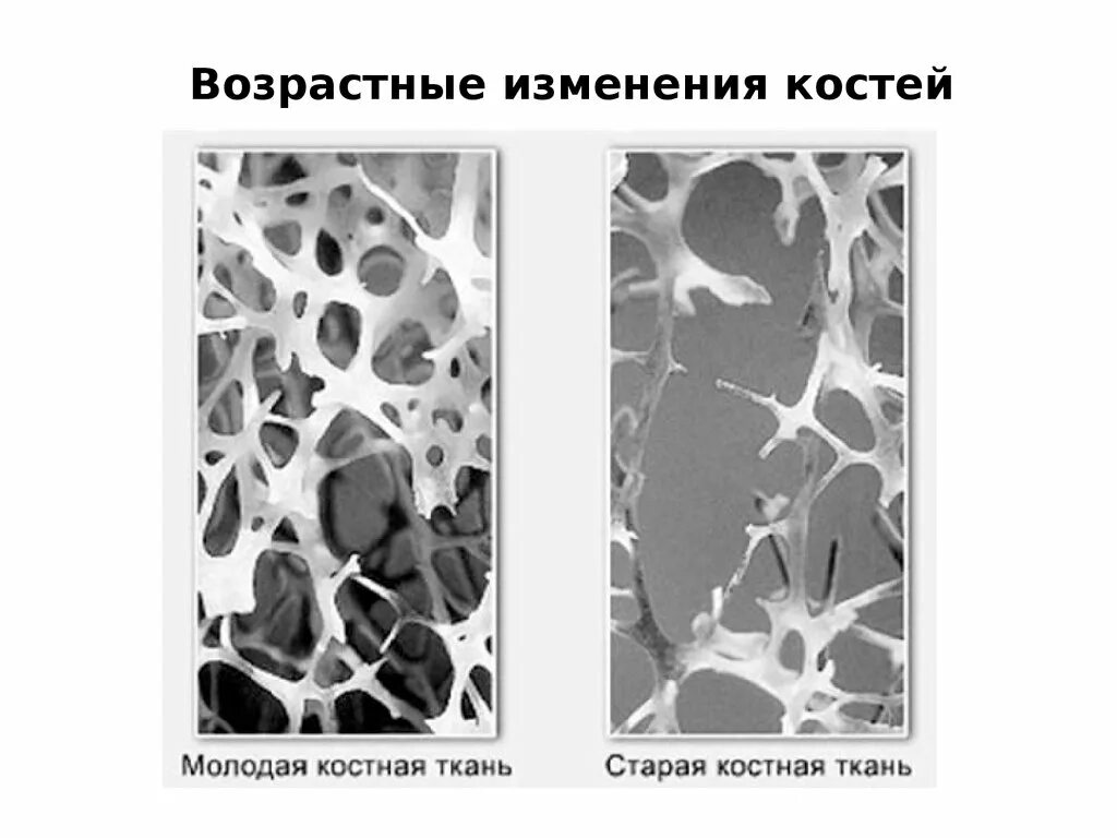 Признаком возрастных изменений костей является. Возрастные изменения кости. Возрастные изменения костной ткани. Изменение структуры костной ткани. Возрастные изменения костных структур.