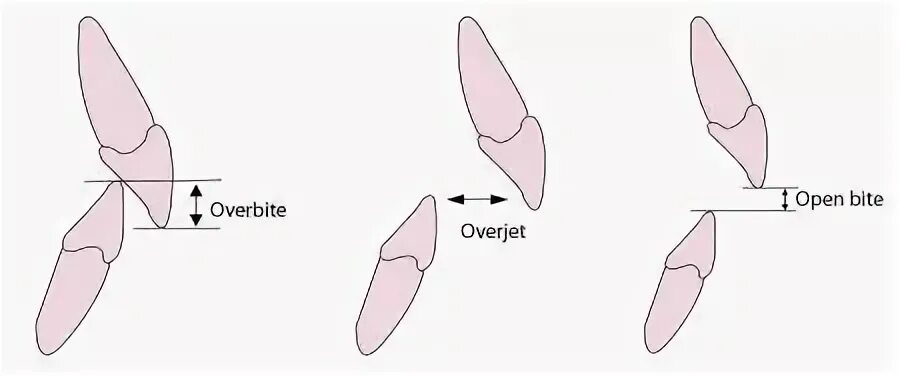 Open bite