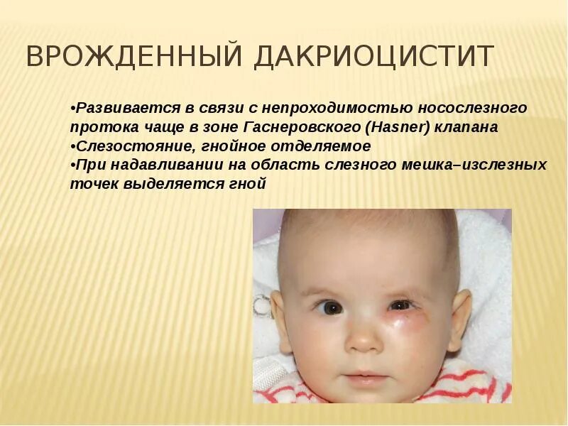 Массаж глаз слезного канала. Схема массажа при дакриоцистите у новорожденных. Врожденный дакриоцистит. Дакриоцистит новорожденных дифференциальный диагноз. Врожденная непроходимость носослезного канала.
