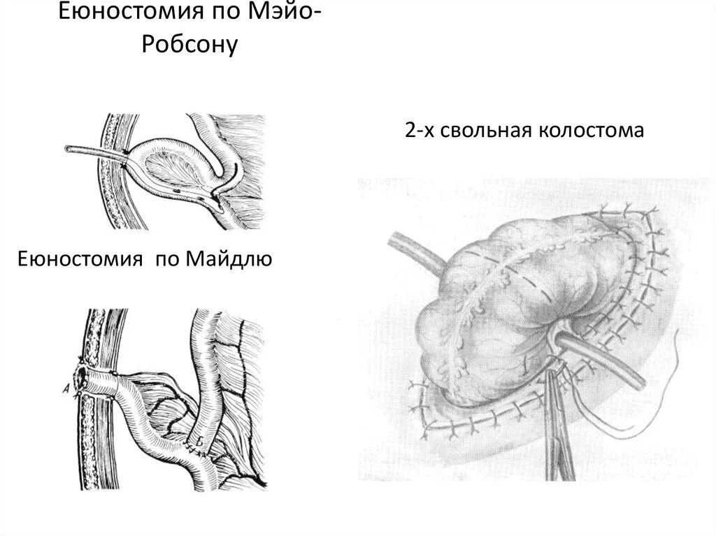 Еюностома это. Еюностома по майдлю техника. еюностомия по майдлю техника операции. еюностомия по витцелю техника.