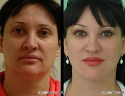 Пациентка 52 лет